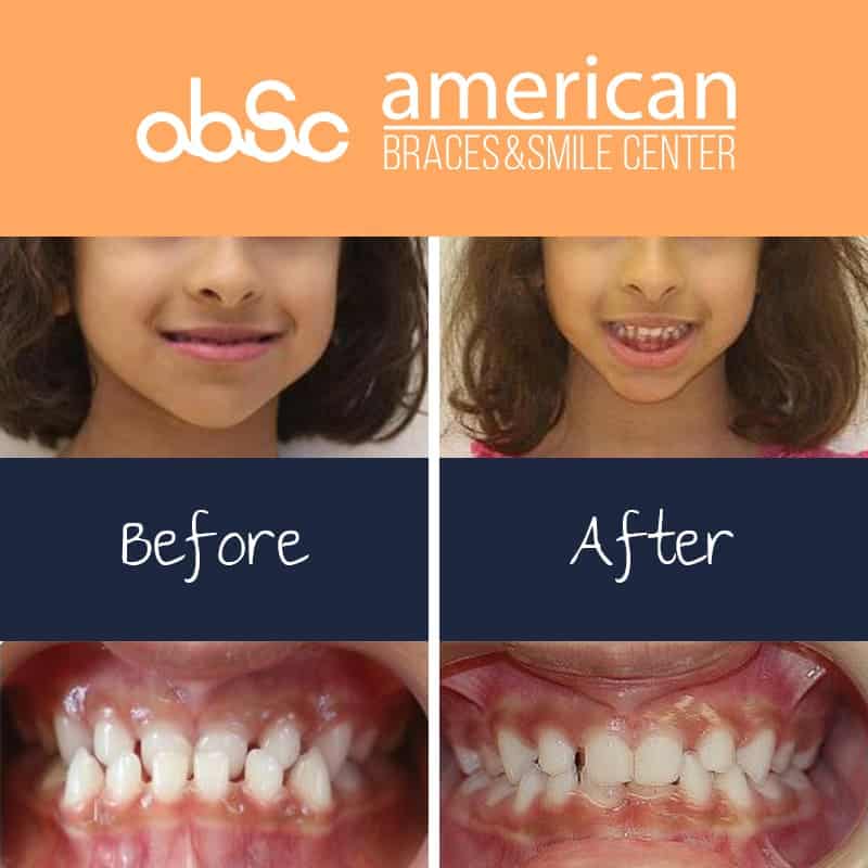 crossbite braces before after