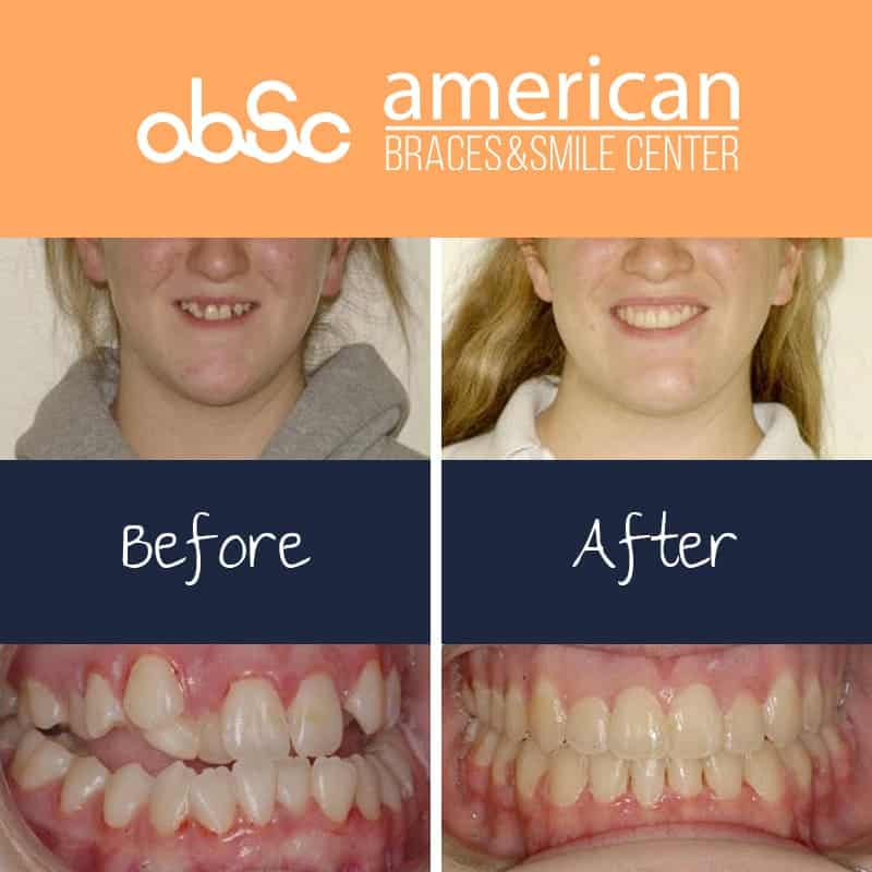 before and after braces adults