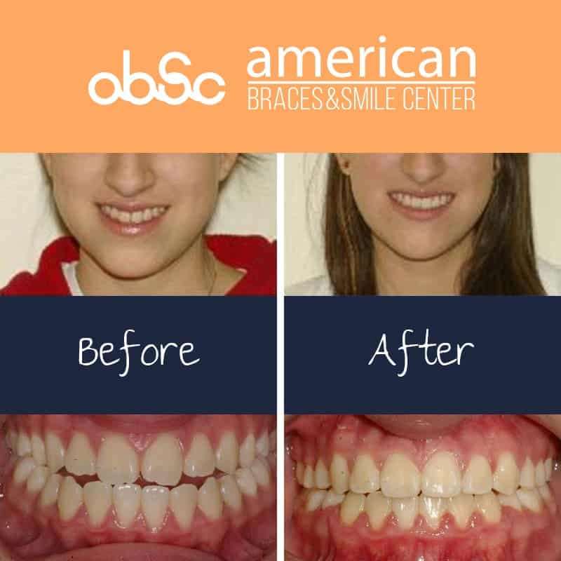 braces before and after open bite