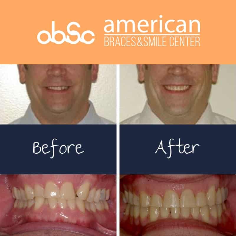 What Is an Overbite? - Bordentown Braces