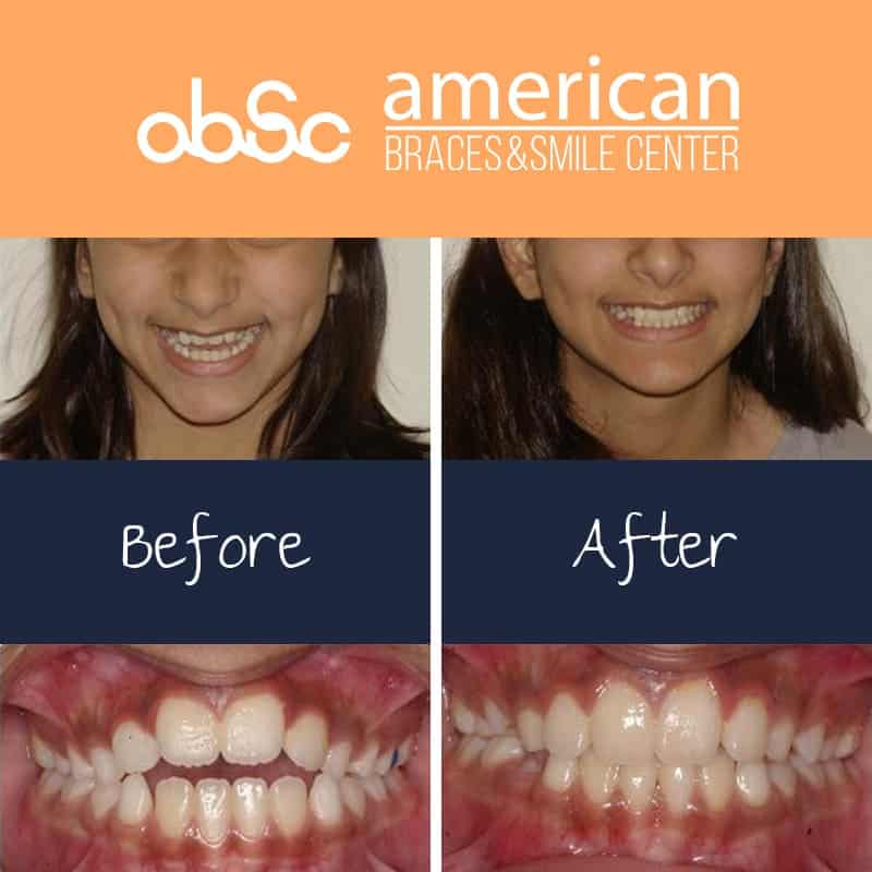 braces before and after open bite