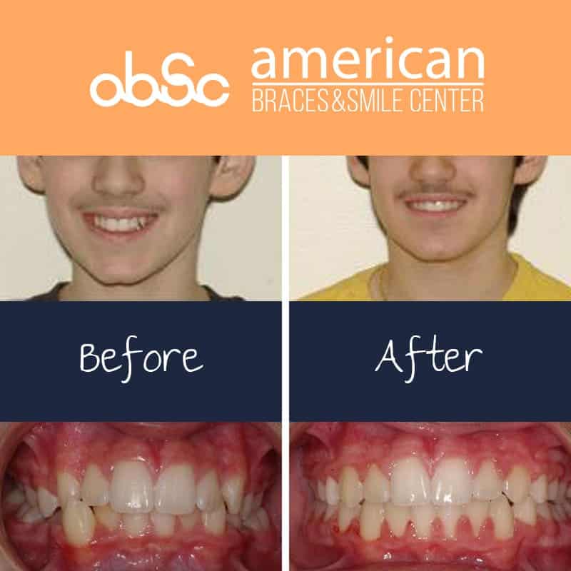 braces before and after gap