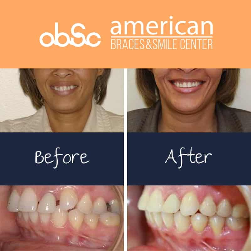 Deep Overbite Before And After  Braces before and after, Misaligned teeth,  After braces