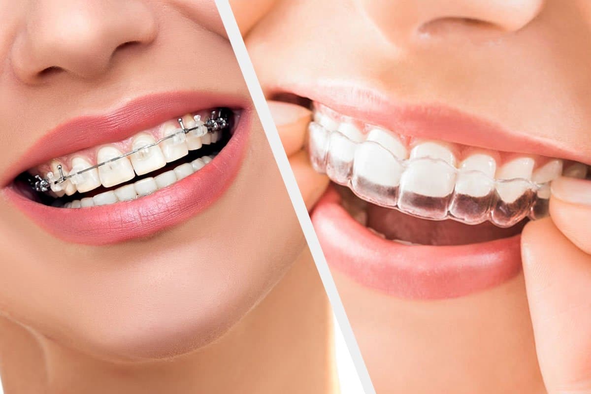 Clear Braces 4 clear braces vs clear aligners