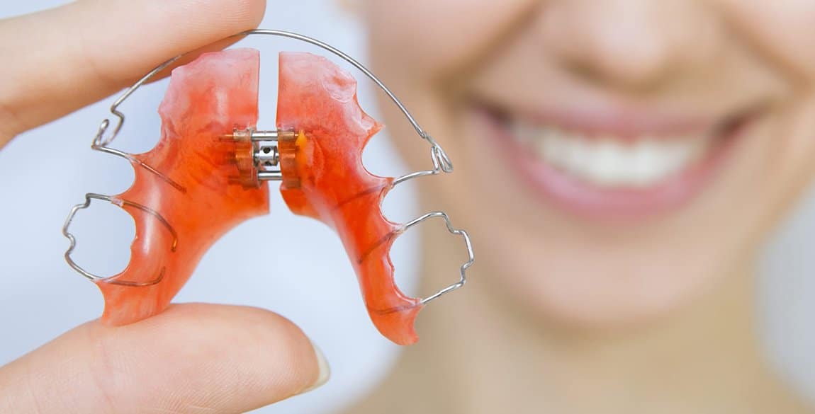 Palatal Expander 2 Palatal Expander