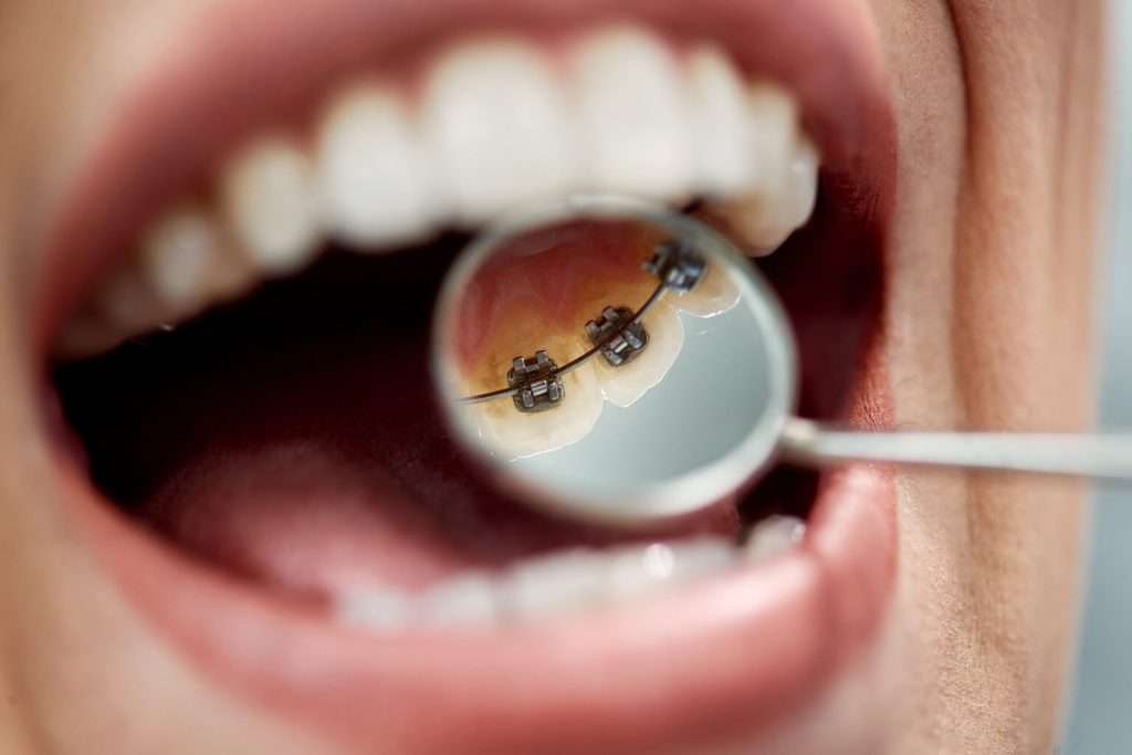 How do you take care of Lingual Braces?