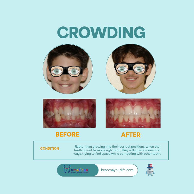 Braces Before and After 8 svg+xml;charset=utf