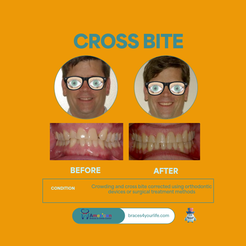 Braces Before and After 9 svg+xml;charset=utf