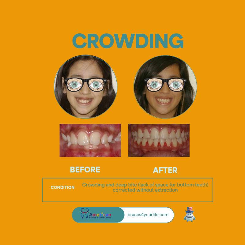 Braces Before and After 11 svg+xml;charset=utf
