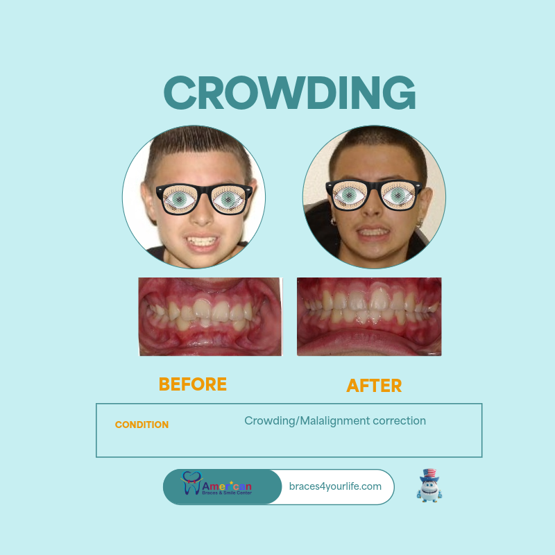 Braces Before and After 12 svg+xml;charset=utf