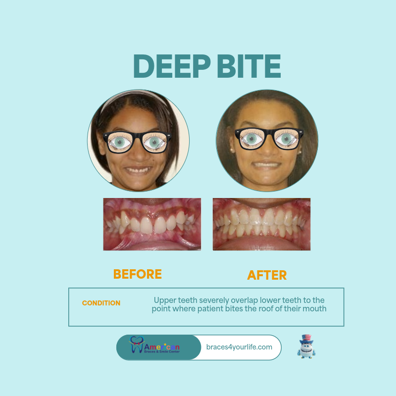 Braces Before and After 13 svg+xml;charset=utf