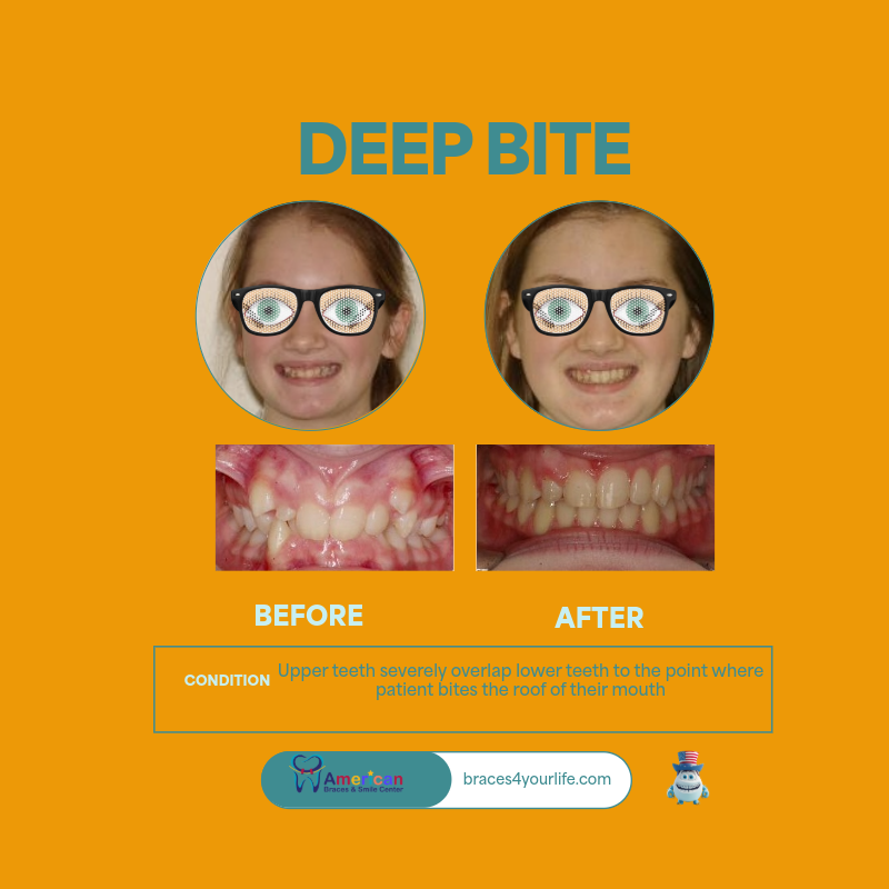 Braces Before and After 14 svg+xml;charset=utf