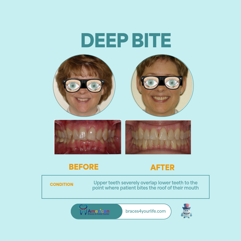 Braces Before and After 16 svg+xml;charset=utf