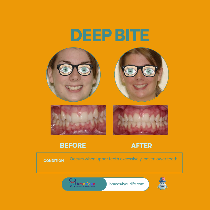 Braces Before and After 15 svg+xml;charset=utf