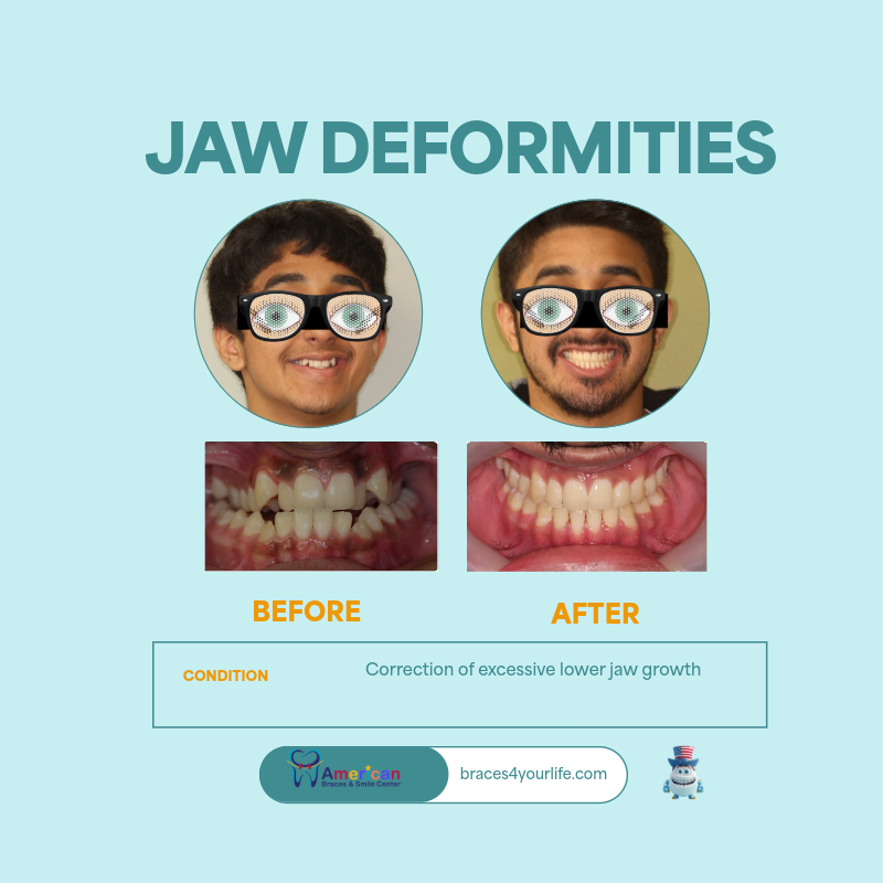 Braces Before and After 26 svg+xml;charset=utf