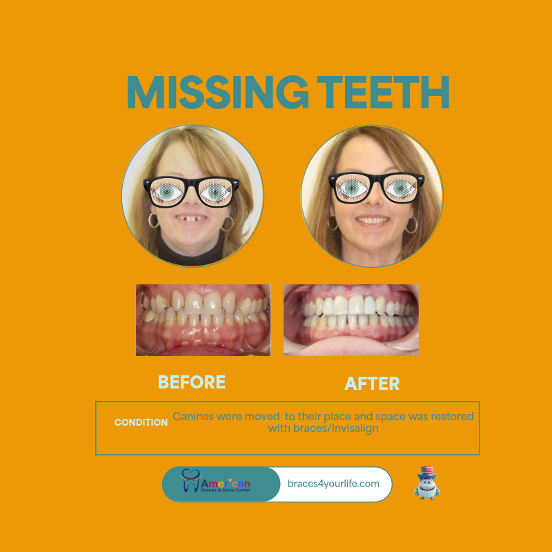 Braces Before and After 29 svg+xml;charset=utf