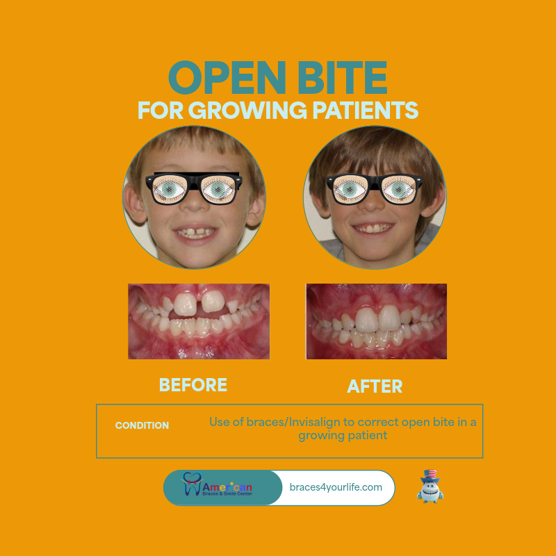 Braces Before and After 5 svg+xml;charset=utf