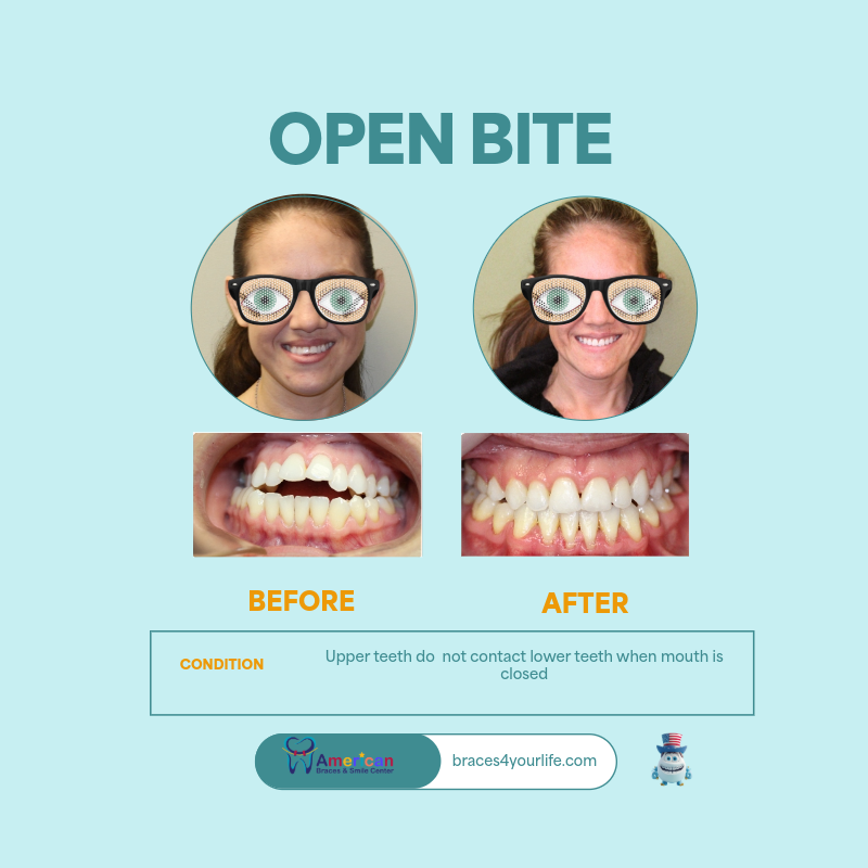 Braces Before and After 7 svg+xml;charset=utf