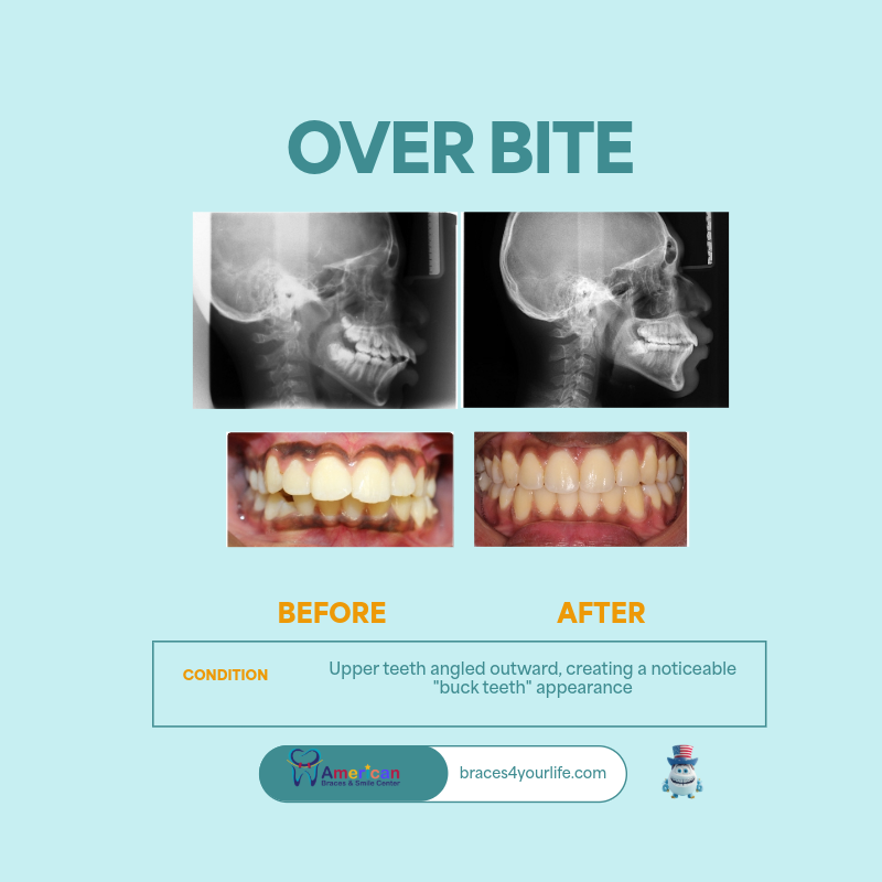 Braces Before and After 19 svg+xml;charset=utf