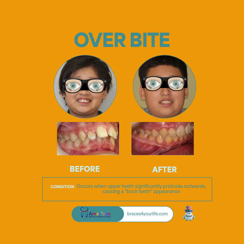 Braces Before and After 20 svg+xml;charset=utf