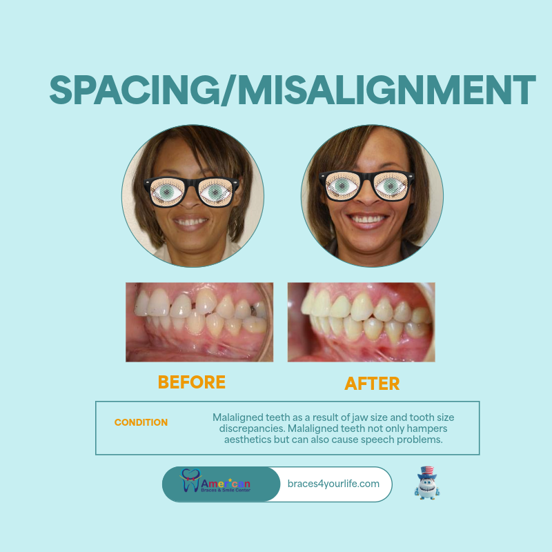 Braces Before and After 25 svg+xml;charset=utf