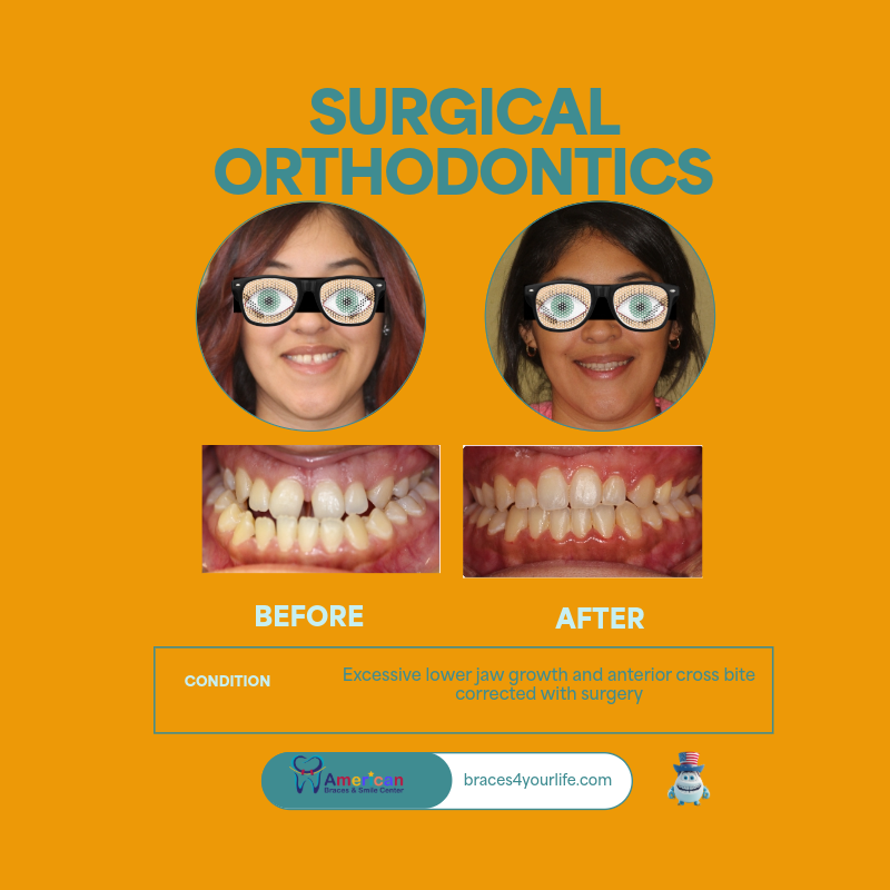 Braces Before and After 18 svg+xml;charset=utf