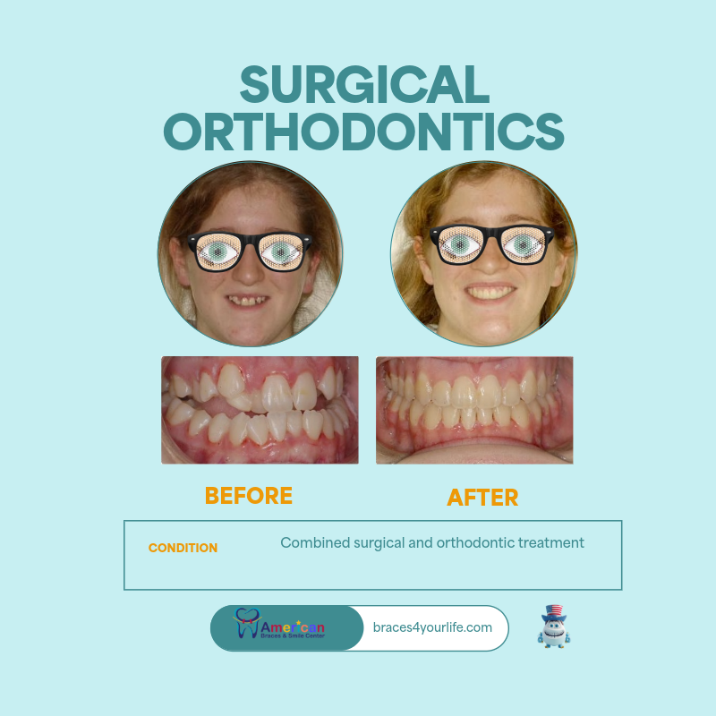 Braces Before and After 17 svg+xml;charset=utf