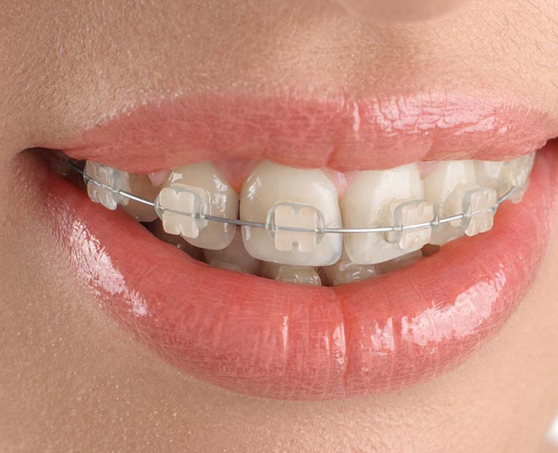 Clear Braces 2 Clear Ceramic Braces