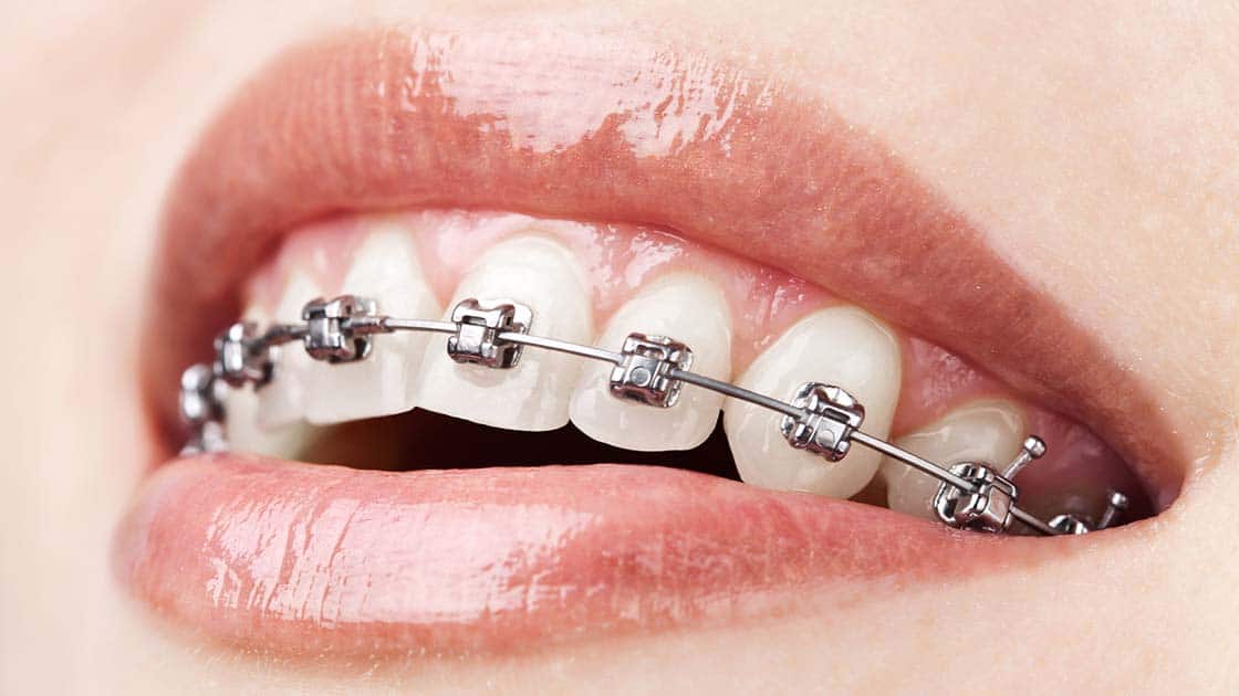 Braces 5 self-litagating-braces-image