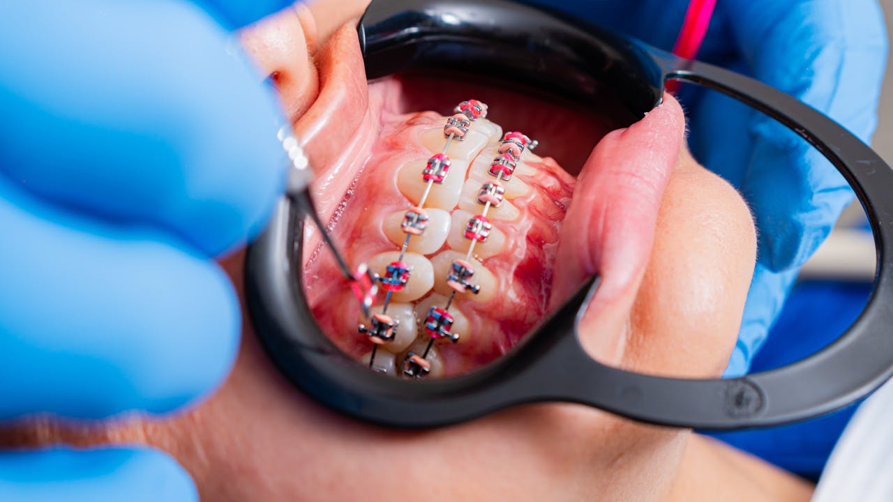 Wearing Elastics With Braces: Why They Matter & How to Use Them