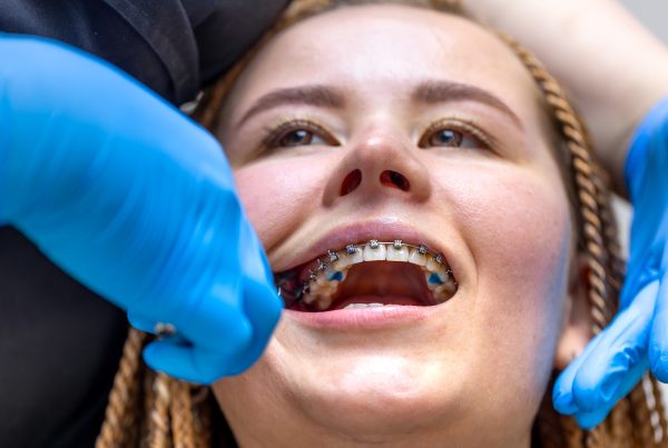 Lingual Braces: Braces Behind Your Teeth, Explained