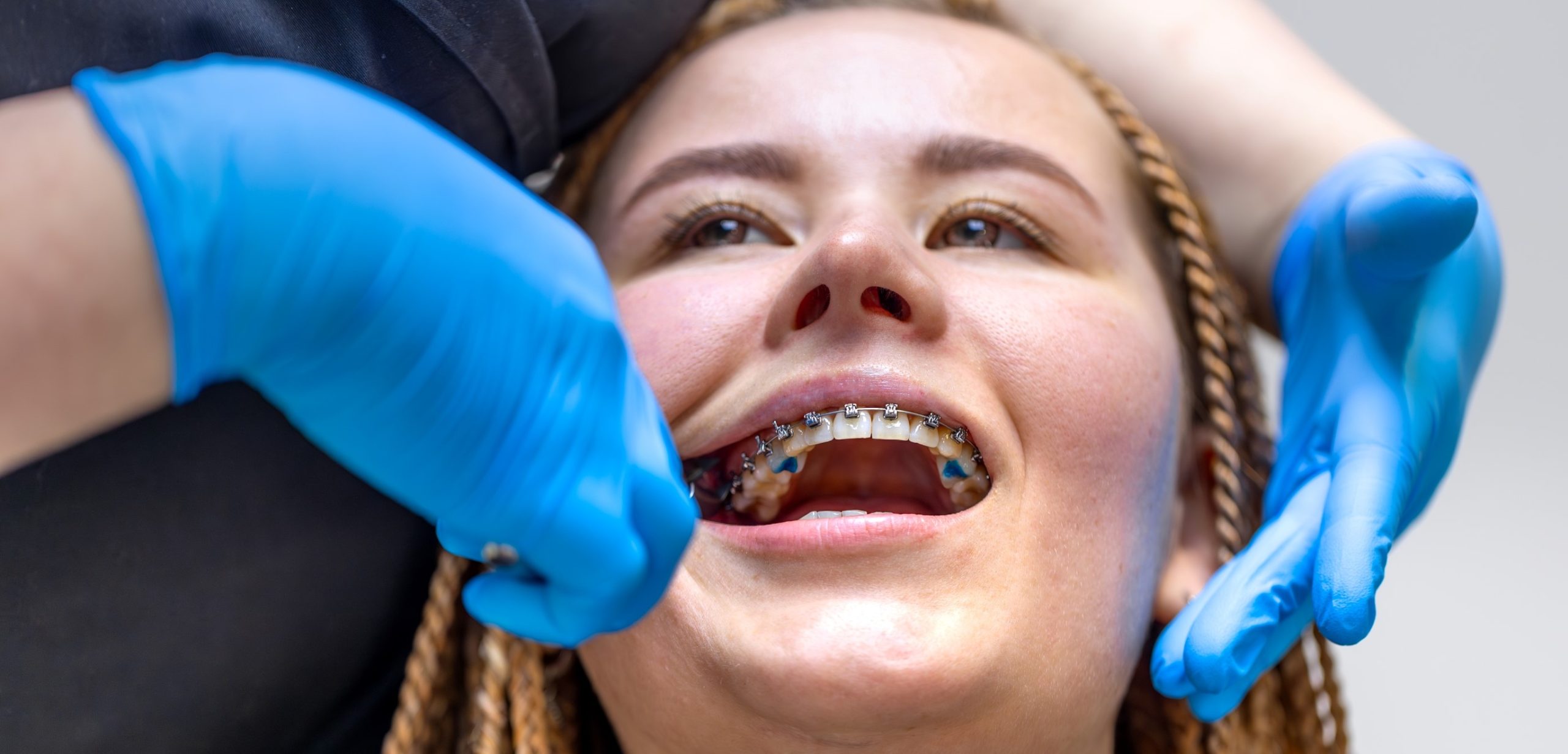 Lingual Braces: Braces Behind Your Teeth, Explained