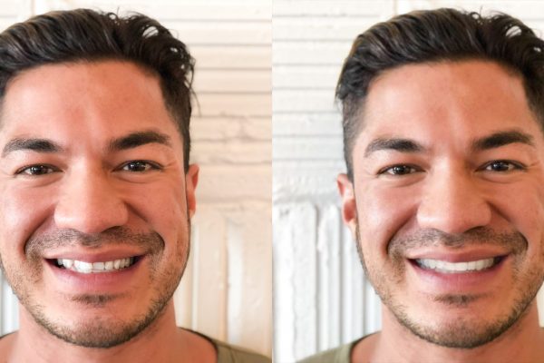SmileView-BeforeAfter02+Shane SmileView-BeforeAfter02+Shane