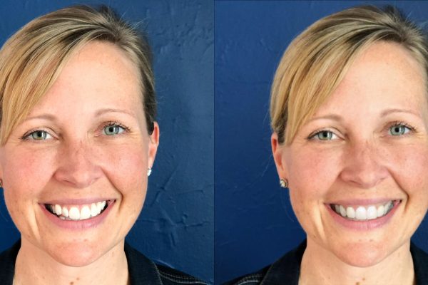 SmileView-BeforeAfter05Lisa SmileView-BeforeAfter05Lisa