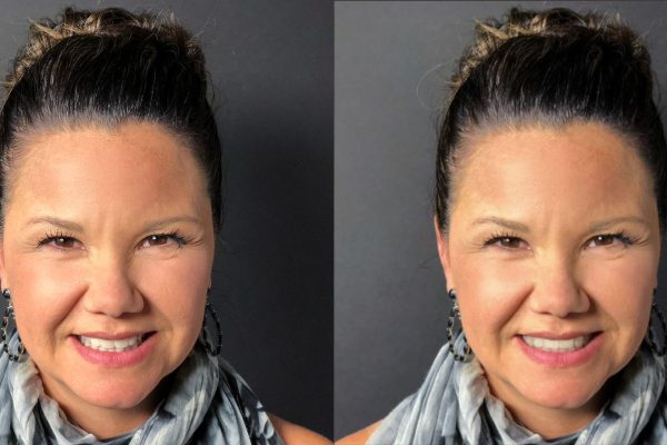SmileView-BeforeAfter06Kym SmileView-BeforeAfter06Kym