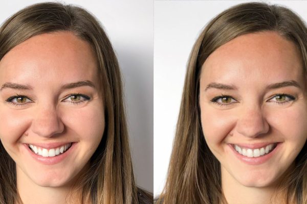 Before and after braces results from ABSC Orthodontics patient in Woodbridge Virginia Before and after braces results from ABSC Orthodontics patient in Woodbridge Virginia