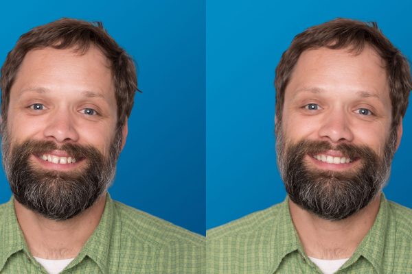SmileView-BeforeAfter09Dan SmileView-BeforeAfter09Dan