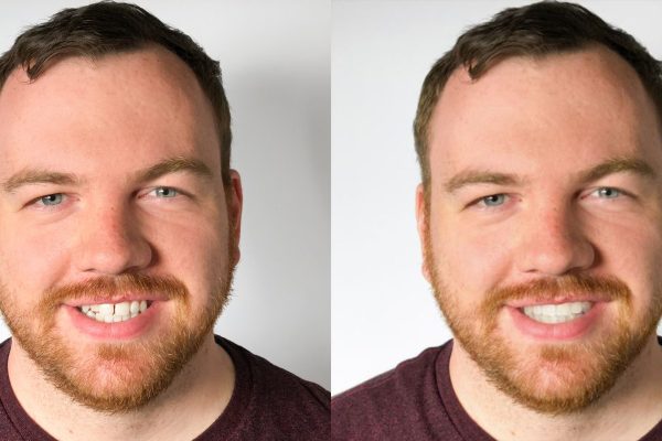 SmileView-BeforeAfter10Brian SmileView-BeforeAfter10Brian