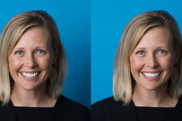 SmileView-BeforeAfter12 SmileView-BeforeAfter12